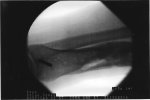 Left ankle X-ray
