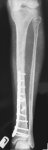 Left leg X-ray