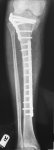 Right leg X-ray