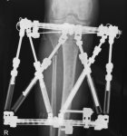 TSF X-ray May