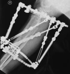 TSF X-ray June