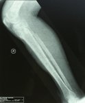 Right leg final