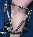 TSF on leg
